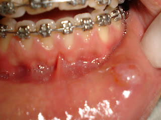 Mucocele labial cie 10